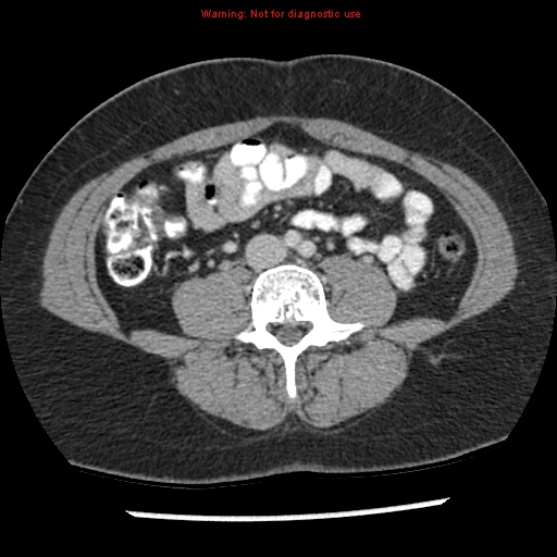 Acute appendicitis (Radiopaedia 7966-8812 C+ portal venous phase 28).jpg