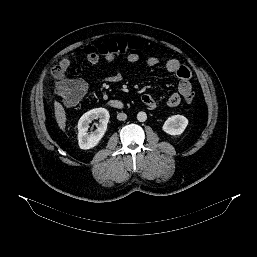 File:Acute appendicitis (Radiopaedia 79950-93224 Axial C+ portal venous phase 51).jpg