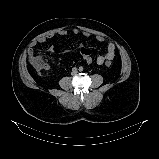 File:Acute appendicitis (Radiopaedia 79950-93224 Axial non-contrast 62).jpg