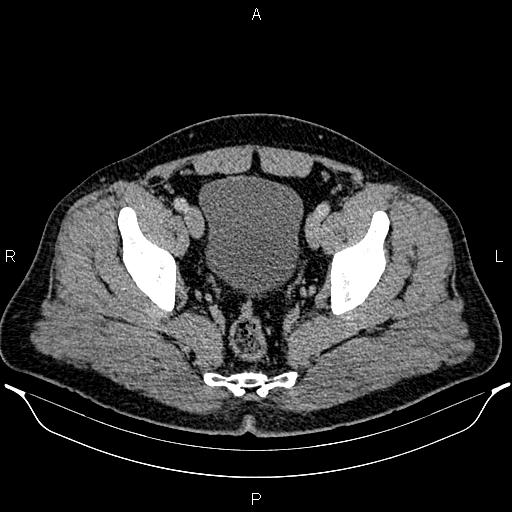 Acute appendicitis (Radiopaedia 84780-100240 Axial C+ portal venous phase 96).jpg
