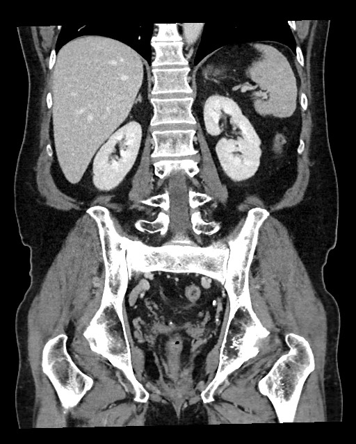 Acute appendicitis - large appendicoliths (Radiopaedia 61805-69820 Coronal C+ portal venous phase 91).jpg