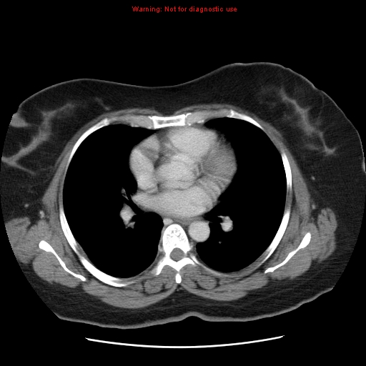Acute appendicitis complicated by ovarian vein thrombophlebitis (Radiopaedia 16172-15851 Axial C+ portal venous phase 2).jpg