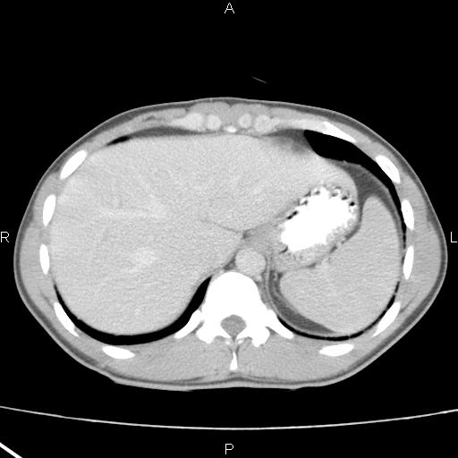 File:Acute appendicitis with CT arrowhead sign (Radiopaedia 21474-21411 Axial C+ portal venous phase 5).jpg