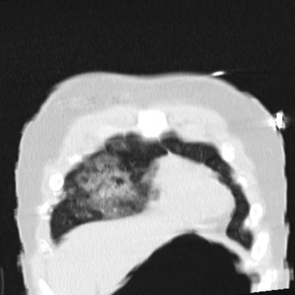Acute aspiration pneumonitis (Radiopaedia 33605-34703 Coronal lung window 17).jpg