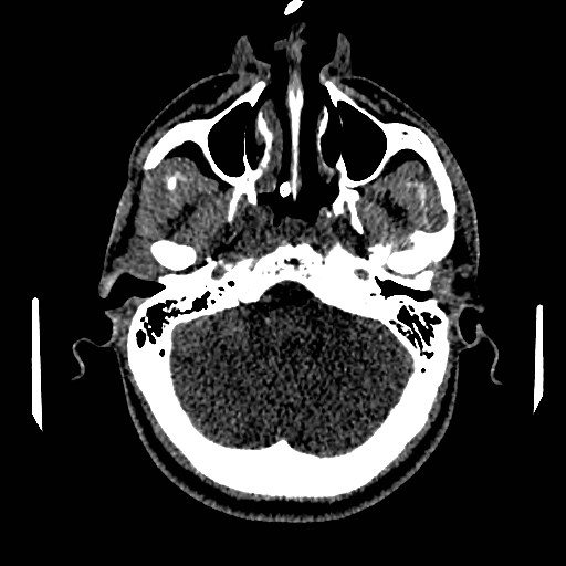 Acute basilar artery occlusion (Radiopaedia 43582-46985 Axial non-contrast 47).jpg