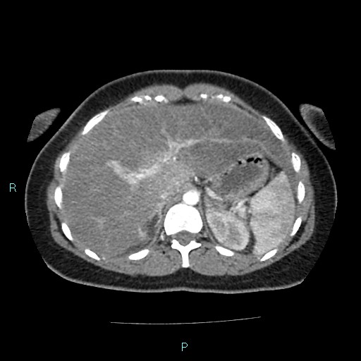 File:Acute bilateral pyelonephritis (Radiopaedia 37146-38881 Axial C+ arterial phase 40).jpg