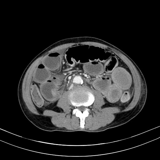 Acute bowel ischemia (Radiopaedia 87695-104114 Axial C+ portal venous phase 46).jpg