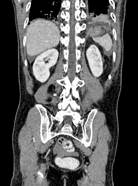 Acute bowel ischemia (Radiopaedia 87695-104114 Coronal C+ portal venous phase 292).jpg