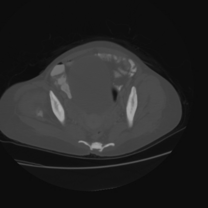 File:Acute calculous cholecystitis in patient with osteopetrosis (Radiopaedia 77871-90159 Axial bone window 43).jpg