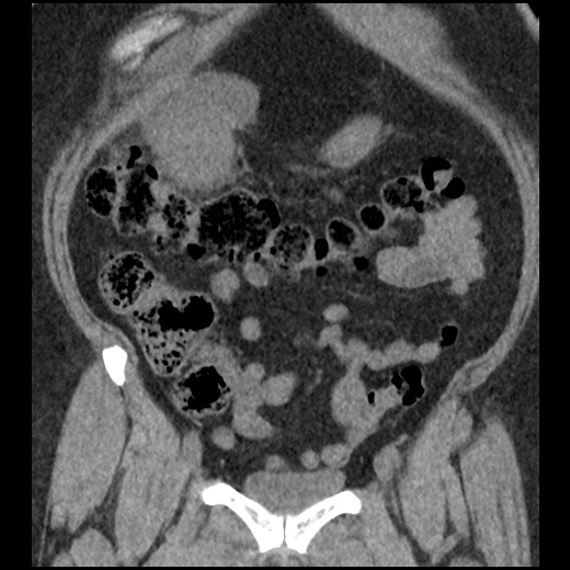 Acute cholecystitis and ureteric colic (Radiopaedia 42330-45444 Coronal prone 34).jpg