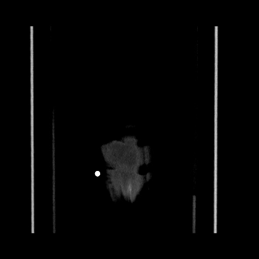 Acute cholecystitis with tensile fundus sign (Radiopaedia 71394-81723 Coronal non-contrast 132).jpg