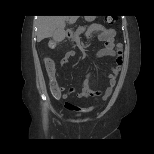 Acute cholecystitis with tensile fundus sign (Radiopaedia 71394-81723 Coronal non-contrast 54).jpg
