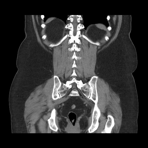 Acute cholecystitis with tensile fundus sign (Radiopaedia 71394-81723 Coronal non-contrast 93).jpg