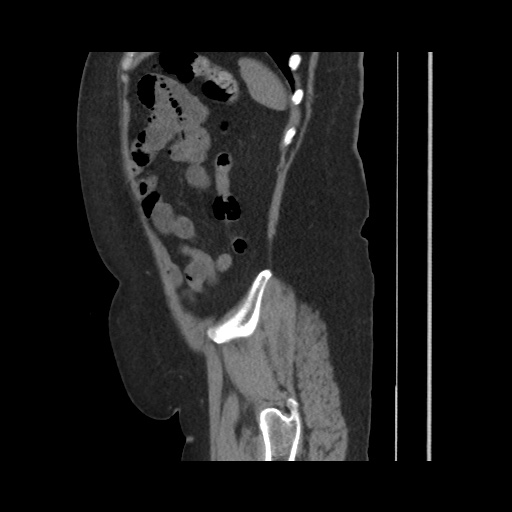 Acute cholecystitis with tensile fundus sign (Radiopaedia 71394-81723 Sagittal non-contrast 135).jpg