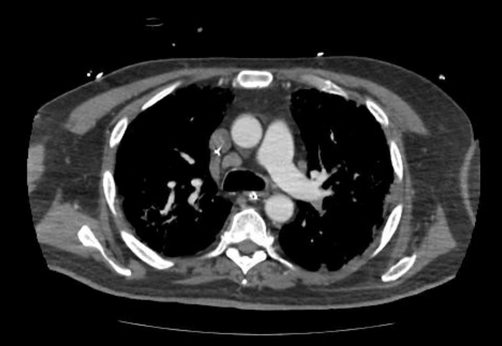 File:Acute cor pulmonale (ultrasound) (Radiopaedia 83508-98818 Axial C+ CTPA 27).jpg