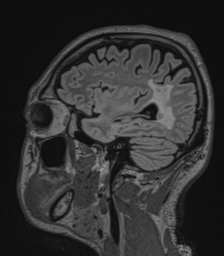 Acute disseminated encephalomyelitis (ADEM)- Anti-NMDA receptor encephalitis (Radiopaedia 54920-61201 Sagittal FLAIR 61).png