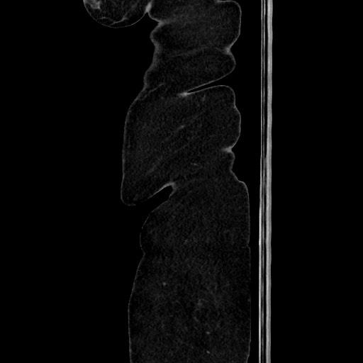 Acute diverticulitis - transverse colon (Radiopaedia 87063-103327 Sagittal C+ portal venous phase 27).jpg