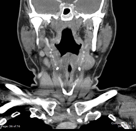 File:Acute epiglottitis (Radiopaedia 54375-60590 Coronal C+ arterial phase 36).jpg