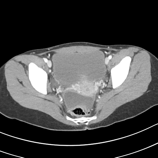 Acute gangrenous appendicitis with perforation (Radiopaedia 40152-42662 Axial C+ portal venous phase 66).png
