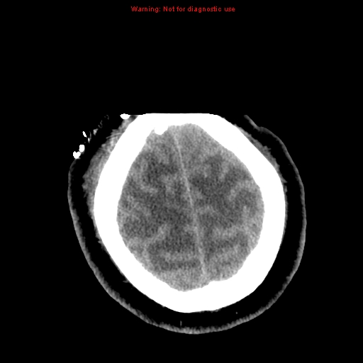 File:Acute hemorrhagic leukoencephalitis (Radiopaedia 14076-72275 Axial non-contrast 40).jpg