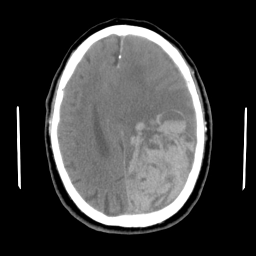 Acute hemorrhagic stroke (Radiopaedia 17507-17223 Axial non-contrast 35).jpg