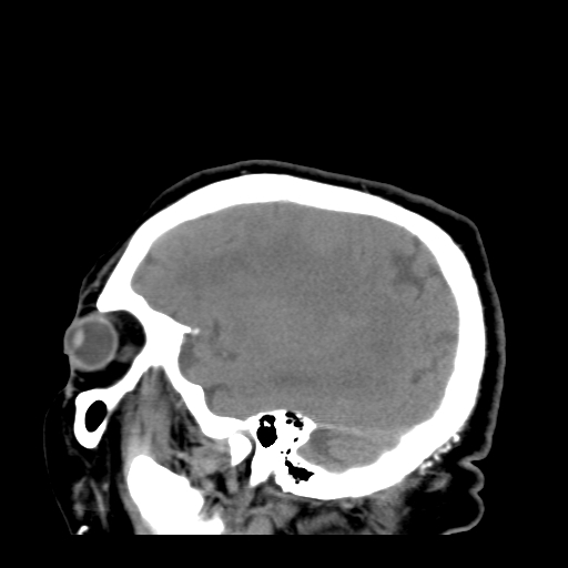 File:Acute hemorrhagic stroke (Radiopaedia 17507-17223 Sagittal non-contrast 36).jpg