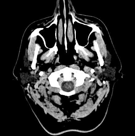 Acute internal carotid artery dissection (Radiopaedia 53541-59558 Axial non-contrast 1).jpg