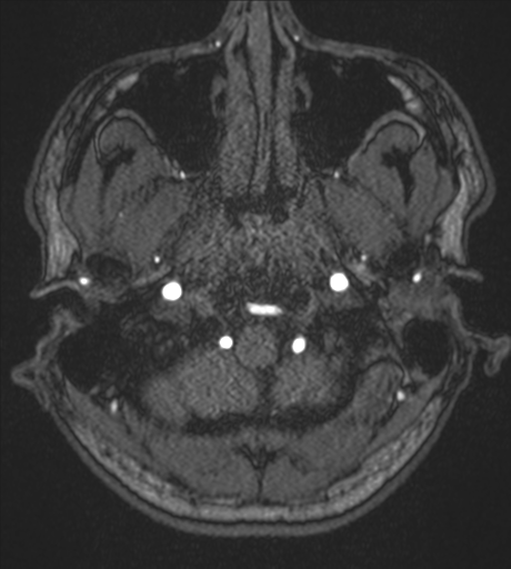 Acute left middle cerebral artery territory infarct with clot retrieval (Radiopaedia 47732-52433 Axial MRA 4).png