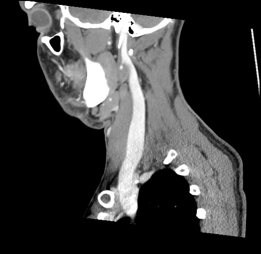 Acute longus colli calcific tendinitis (Radiopaedia 72495-83036 Sagittal C+ arterial phase 51).jpg