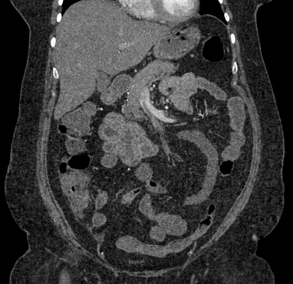 Acute mesenteric ischemia (Radiopaedia 80029-93316 Coronal C+ arterial phase 51).jpg
