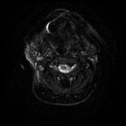 Acute otitis externa (Radiopaedia 57296-64236 Axial DWI 45).jpg