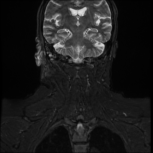 File:Acute otitis externa (Radiopaedia 57296-64236 Coronal STIR 17).jpg