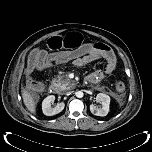 Acute pancreatic necrosis (Radiopaedia 13560-18500 Axial C+ portal venous phase 64).jpg