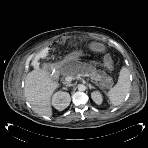 Acute pancreatic necrosis (Radiopaedia 13560-18503 Axial C+ portal venous phase 24).jpg