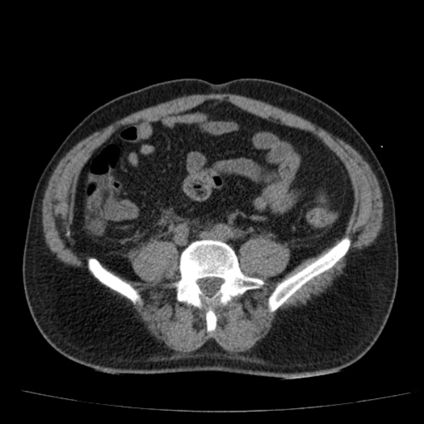 Acute pancreatitis (Radiopaedia 26663-26813 Axial non-contrast 67).jpg