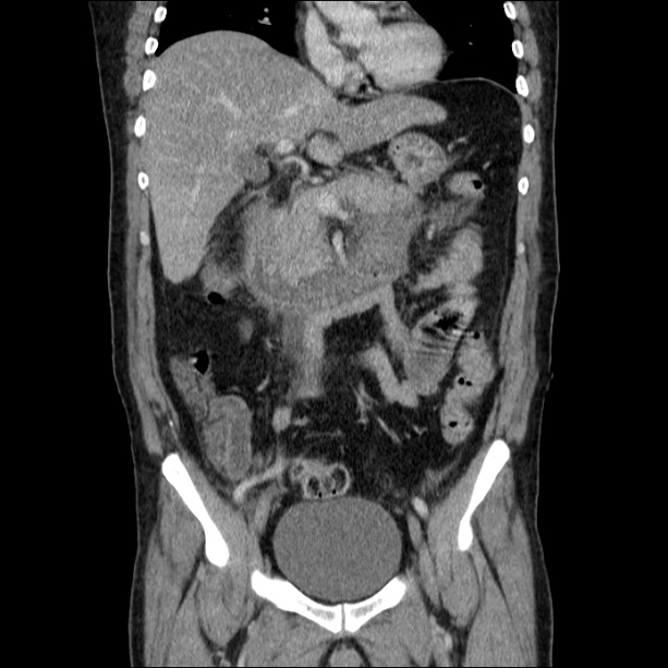 Acute pancreatitis (Radiopaedia 26663-26813 Coronal C+ portal venous phase 30).jpg