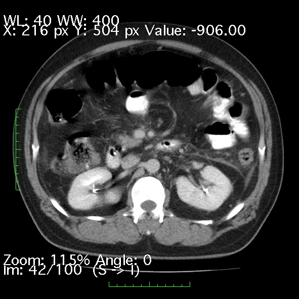 Acute pancreatitis (Radiopaedia 34043-35276 Axial C+ portal venous phase 42).jpg
