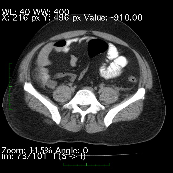 Acute pancreatitis (Radiopaedia 34043-35276 Axial non-contrast 73).jpg
