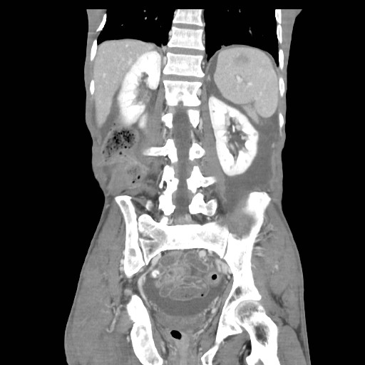 File:Acute pancreatitis (Radiopaedia 50213-55558 Coronal C+ portal venous phase 33).jpg