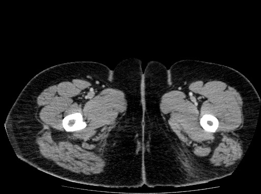 Acute pancreatitis (Radiopaedia 69236-79012 Axial C+ portal venous phase 97).jpg