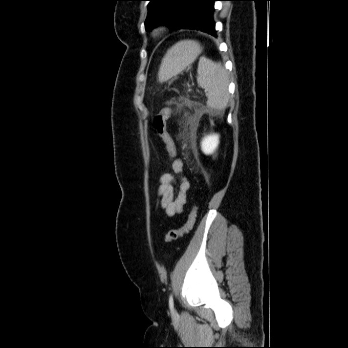 Acute pancreatitis (Radiopaedia 69236-79012 Sagittal C+ portal venous phase 29).jpg