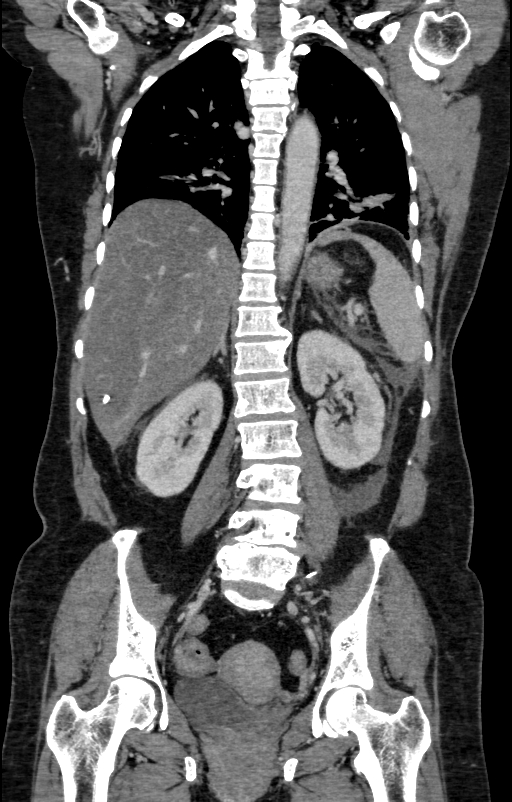 Acute pancreatitis (Radiopaedia 80007-93285 Coronal C+ portal venous phase 99).jpg