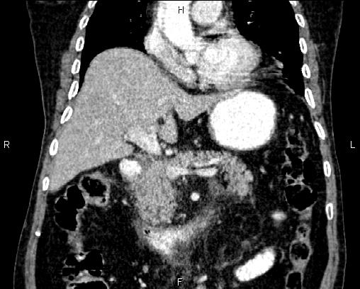 Acute pancreatitis (Radiopaedia 85146-100701 Coronal C+ portal venous phase 34).jpg