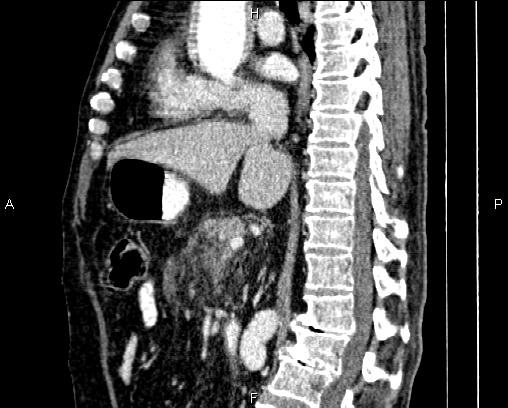 Acute pancreatitis (Radiopaedia 85146-100701 Sagittal C+ portal venous phase 45).jpg