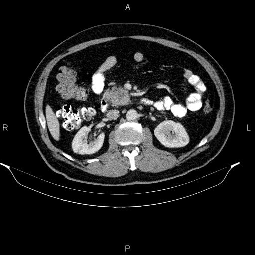 Acute pancreatitis (Radiopaedia 85390-101010 Axial C+ portal venous phase 44).jpg