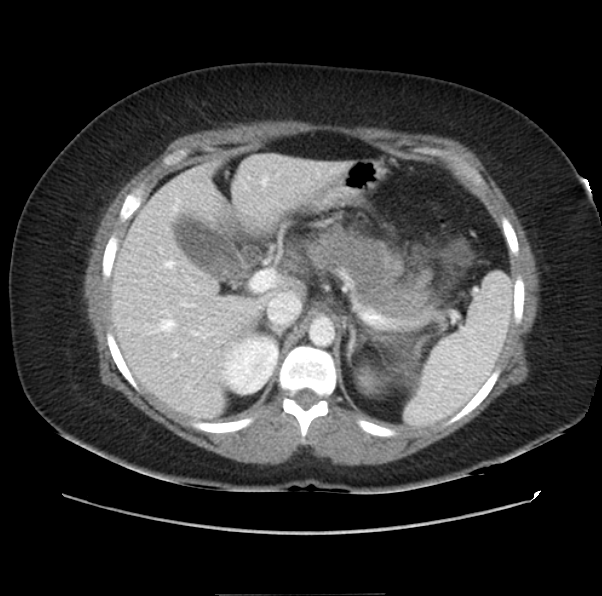 File:Acute pancreatitis - Balthazar E (Radiopaedia 29016-29377 Axial C+ portal venous phase 19).png