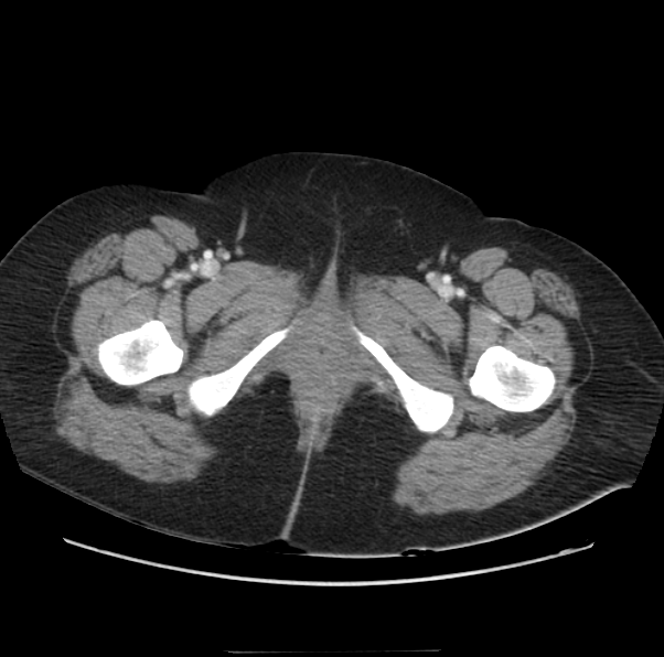 File:Acute pancreatitis - Balthazar E (Radiopaedia 29016-29377 Axial C+ portal venous phase 80).png