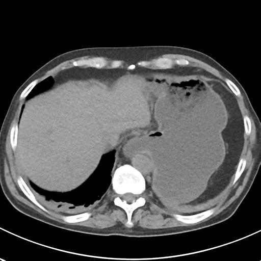 File:Acute pancreatitis and walled-off necrosis (Radiopaedia 29888-30404 Axial non-contrast 10).jpg