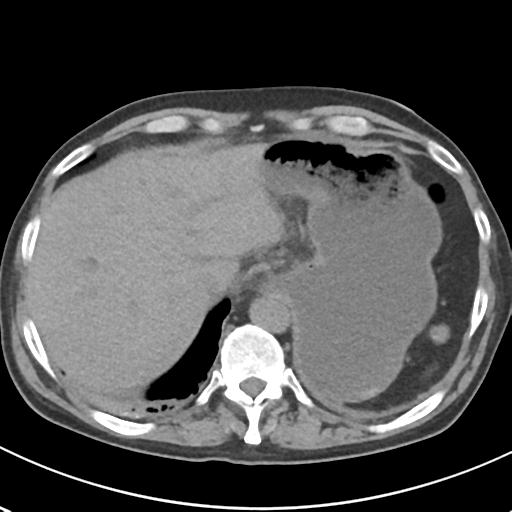 File:Acute pancreatitis and walled-off necrosis (Radiopaedia 29888-30404 Axial non-contrast 12).jpg