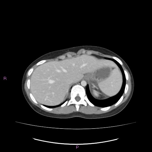 Acute pancreatitis secondary to stone at minor papilla and pancreatic divisum (Radiopaedia 76570-88333 Axial C+ portal venous phase 14).jpg